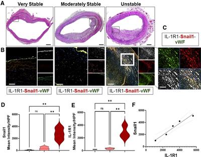 The interleukin-1 receptor type-1 in disturbed flow-induced endothelial mesenchymal activation